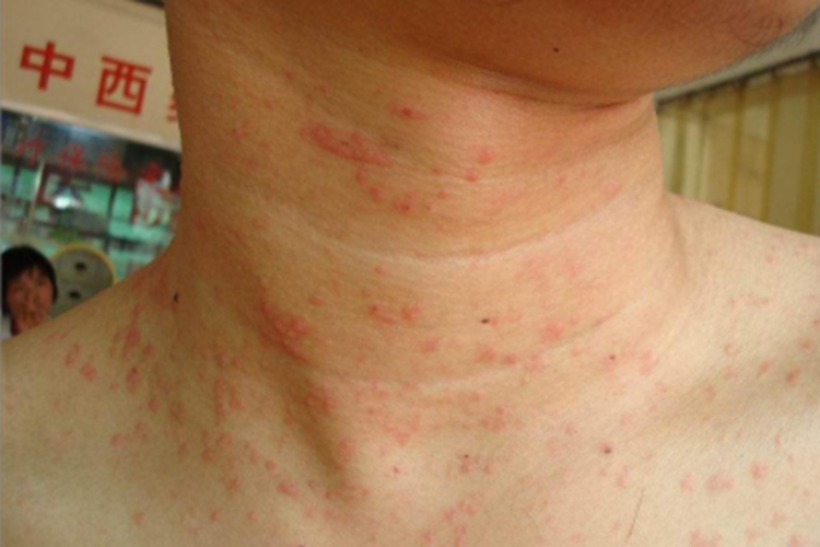 马拉色菌毛囊炎侧颈红斑图 马拉色菌毛囊炎侧颈红斑图