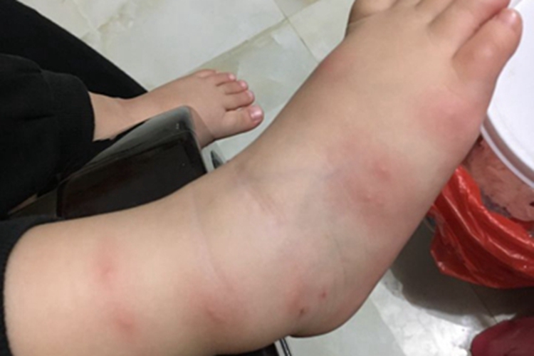 跳蚤叮咬脚背小疙瘩图