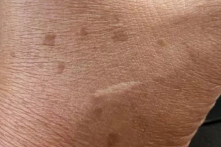 脂溢性角化病手部症状图