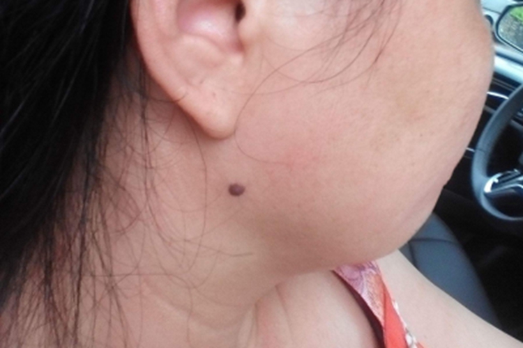 皮内痣耳周痣图