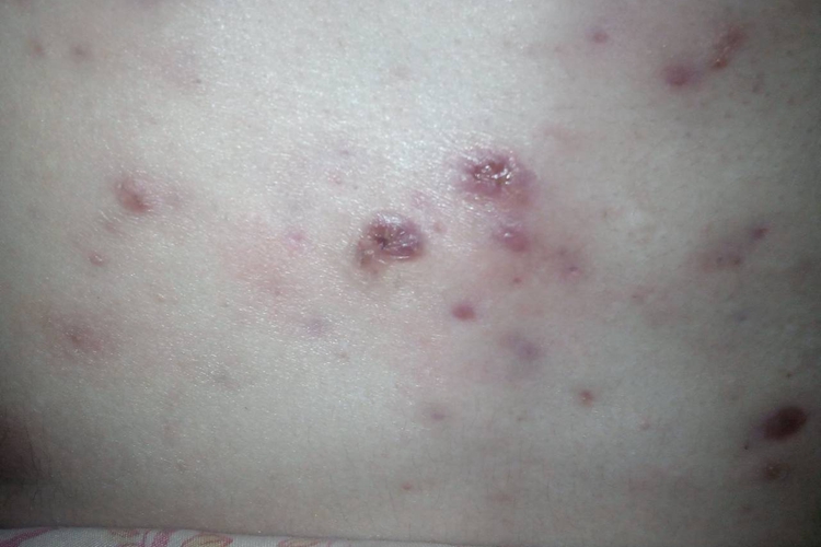 痤疮胸部糜烂图 痤疮胸部糜烂图