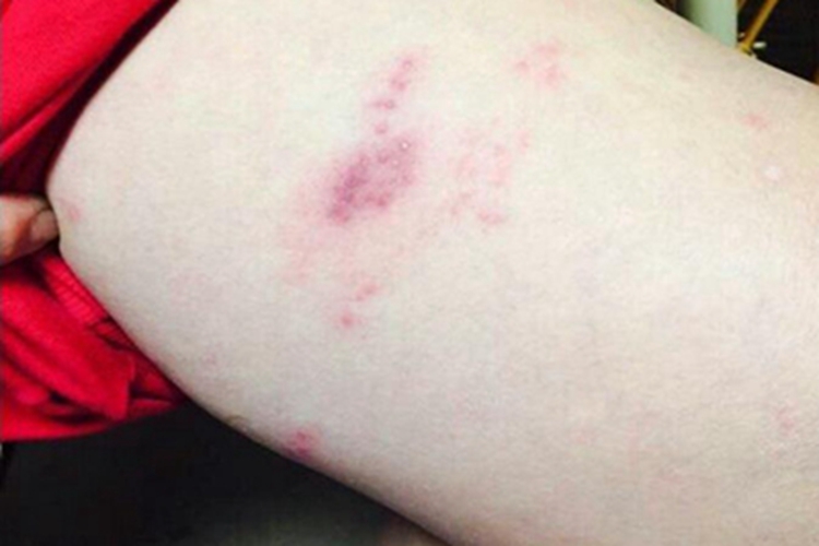 带状疱疹大腿有小水疱图