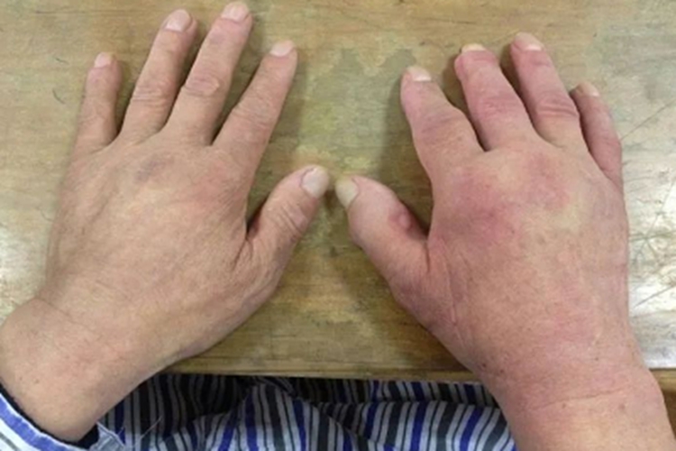 肩手综合征肿胀期水肿图