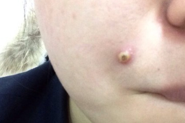 脸上长毒火疖子图