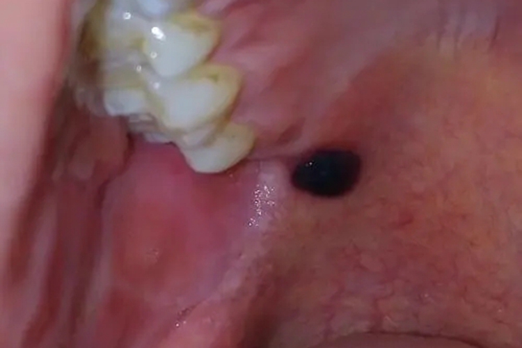 创伤性血疱图 创伤性血疱图