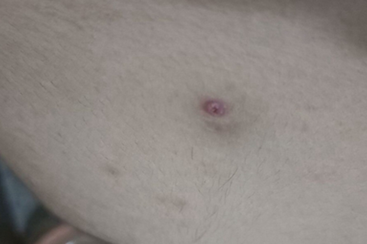 皮脂腺囊肿腹部小坑图 皮脂腺囊肿腹部小坑图