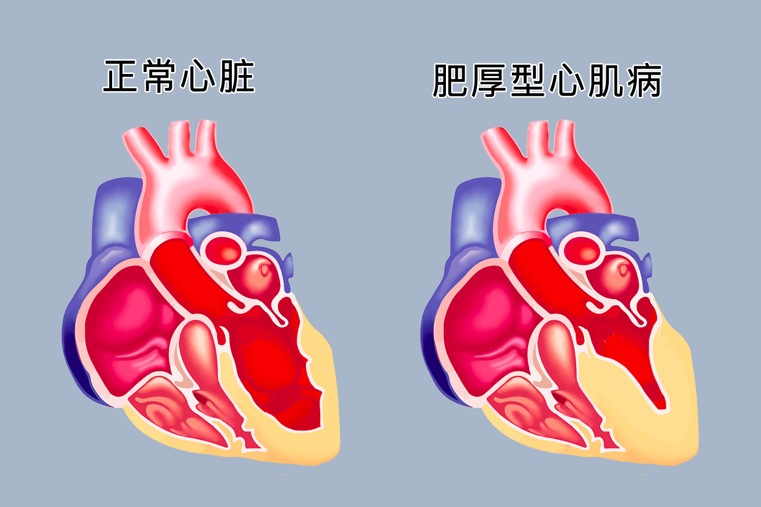 肥厚型心肌病心肌肥大图