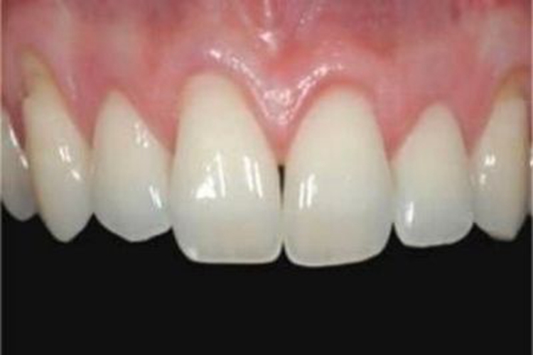 牙龈退缩症状图