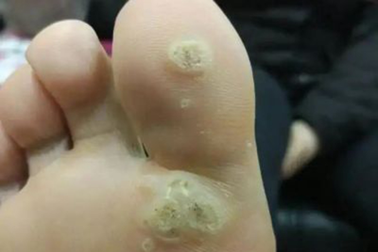 寻常疣脚底有点状黑痂图 寻常疣脚底有点状黑痂图