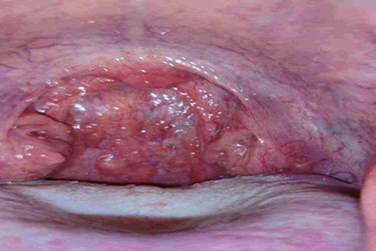 慢性咽炎咽喉血丝图