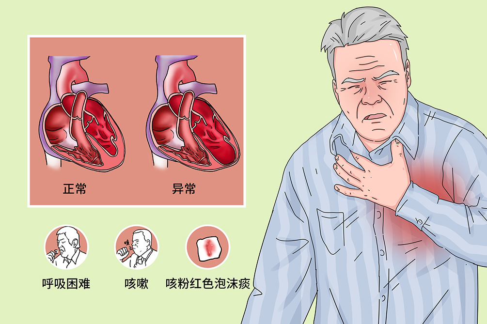 根据病变部位,心力衰竭可分为左心衰竭,右心衰竭和全心衰竭;根据病程
