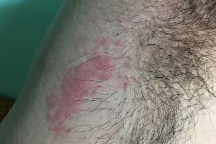 腋窝接触性皮炎图 腋窝接触性皮炎图