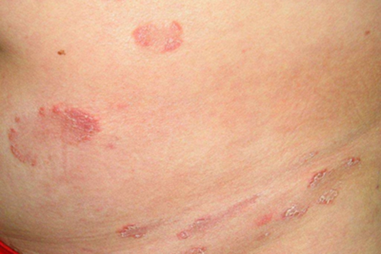 色素性紫癜性皮疹腹部症状图