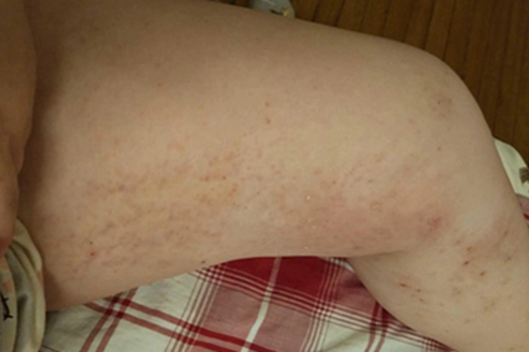 色素性痒疹大腿症状图