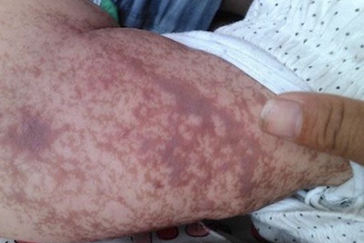 色素失调症胳膊瘢痕图 色素失调症胳膊瘢痕图