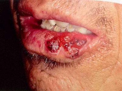 皮肤黏液瘤嘴唇上肿块破溃结痂图
