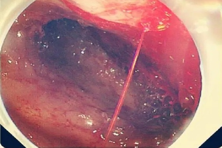 消化道黏膜出血点图