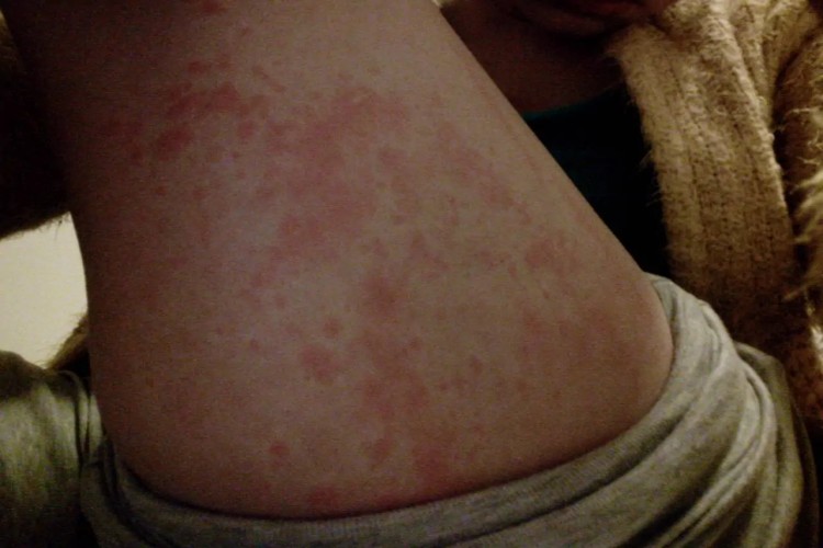 深在性红斑狼疮大腿红斑图