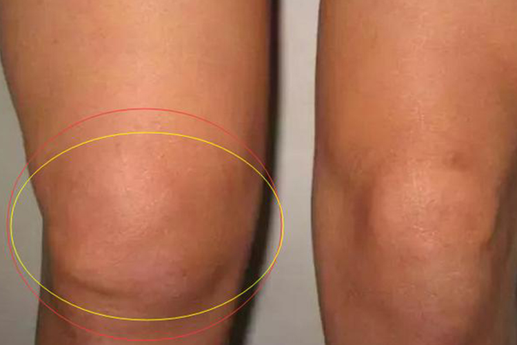 膝关节结核图 膝关节结核图