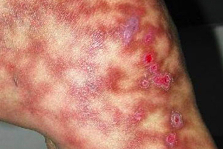 火激红斑脱皮图