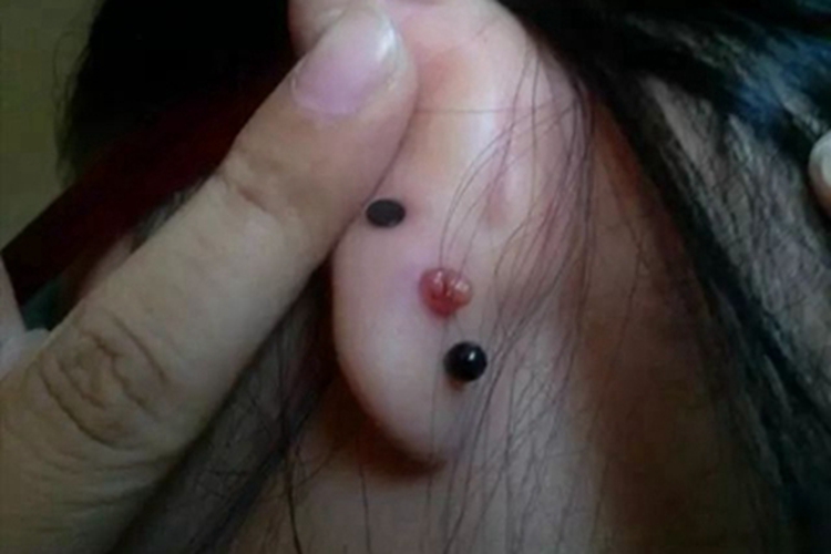 瘢痕疙瘩耳部肉球图 瘢痕疙瘩耳部肉球图