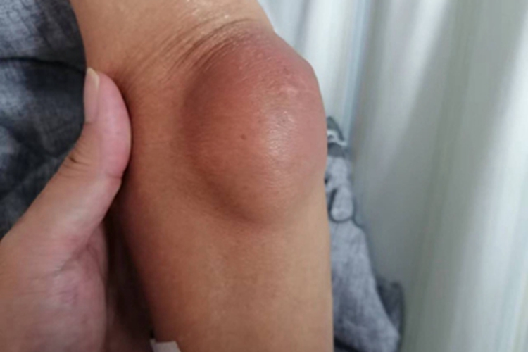 痛风肘部症状图