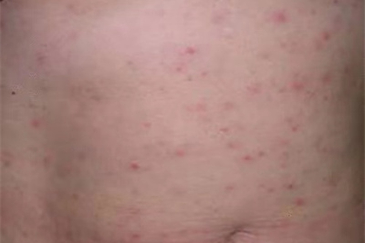 流行性斑疹伤寒腹部丘疹图 流行性斑疹伤寒腹部丘疹图