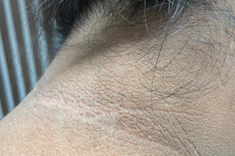 多囊卵巢综合征颈部色素沉着图