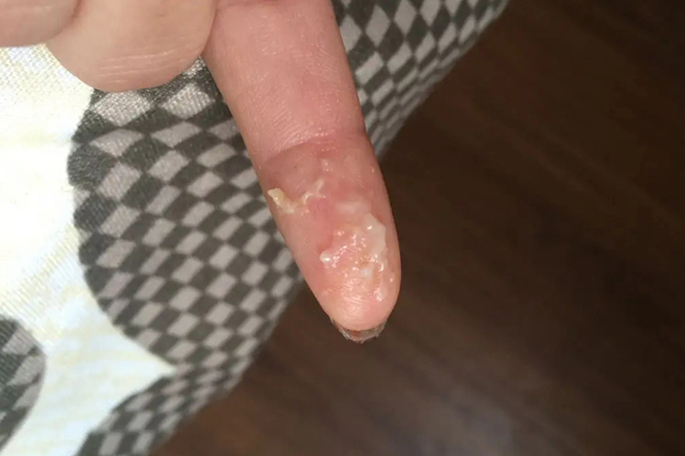 白带发黄豆腐渣样图