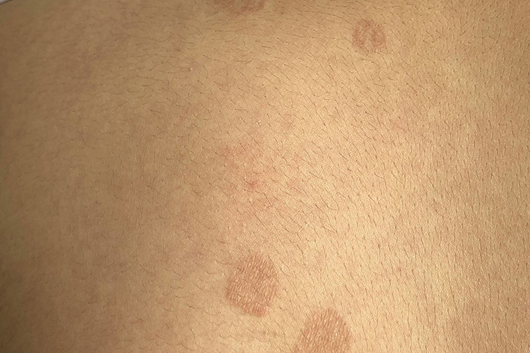 褐色花斑糠疹图