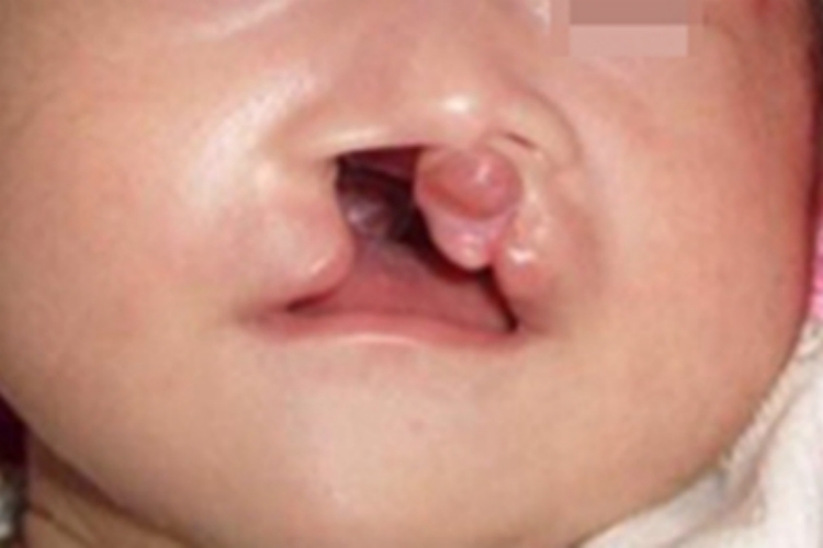唇腭裂嘴唇裂开一个大口图