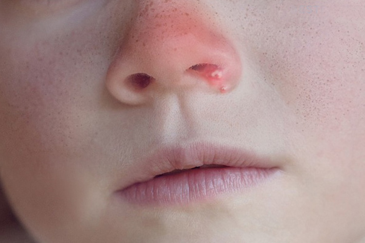 痤疮鼻子下方红红的图 痤疮鼻子下方红红的图