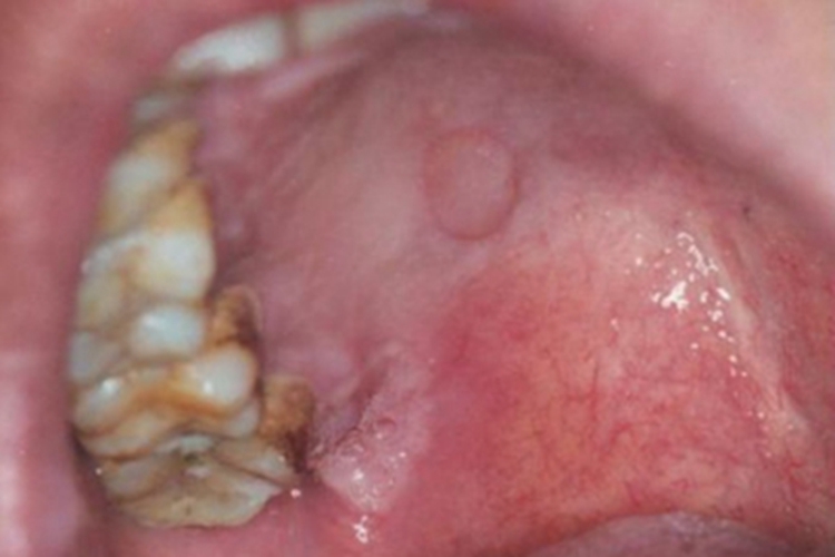 一期口腔梅毒口腔溃疡图 一期口腔梅毒口腔溃疡图