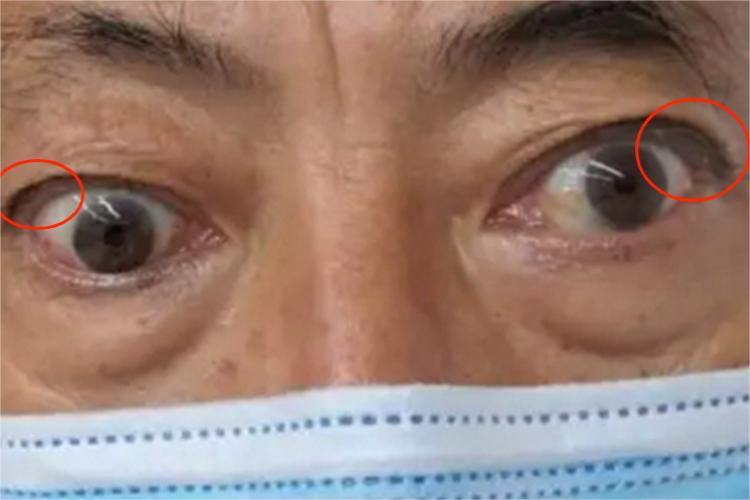 慢性泪腺炎眼球症状图 慢性泪腺炎眼球症状图