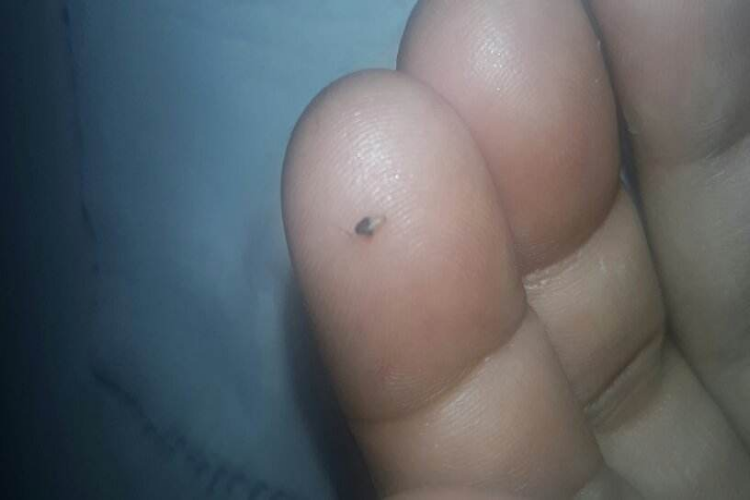 黑头粉刺挤出后图