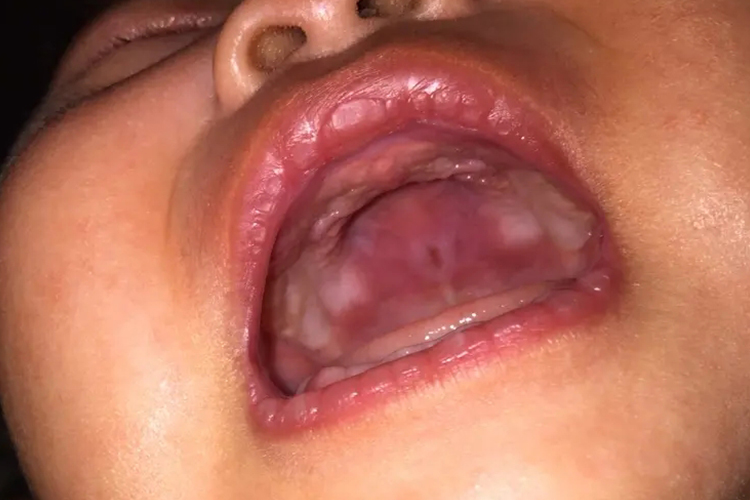 婴儿口腔溃疡初期图