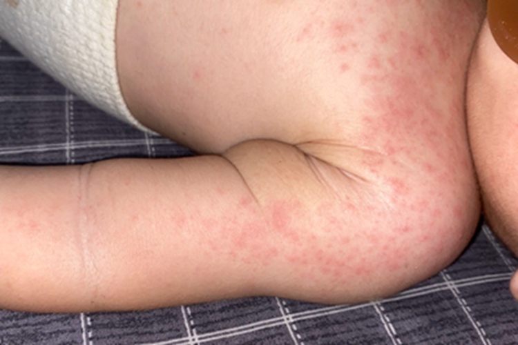 急性接触性皮炎肩部红斑图