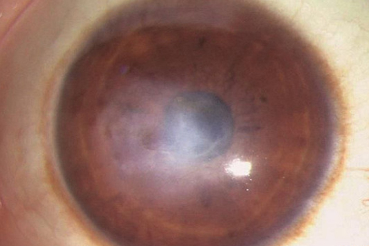 角膜混浊溃疡图