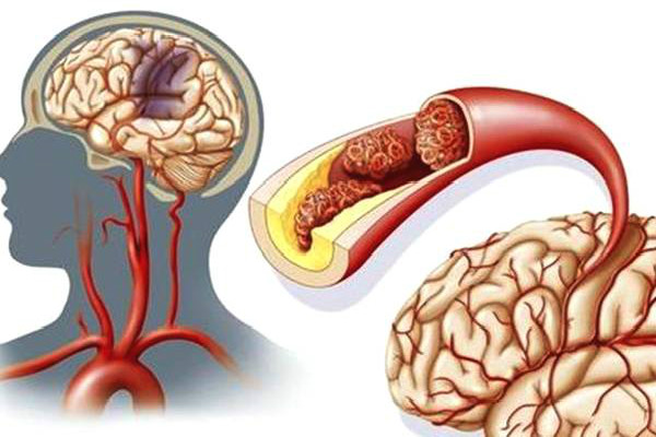 脑血管堵塞1.jpeg