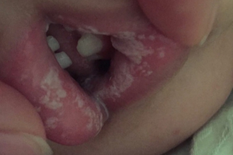 念珠菌性口炎口腔白斑图 念珠菌性口炎口腔白斑图