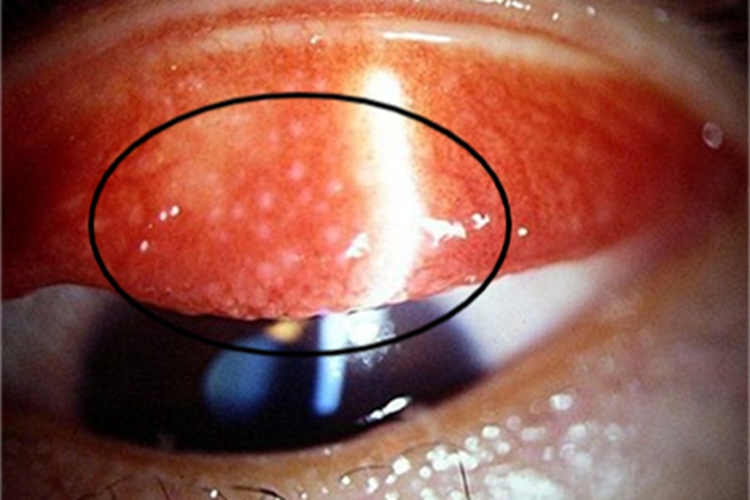 病毒性结膜炎出现白点图