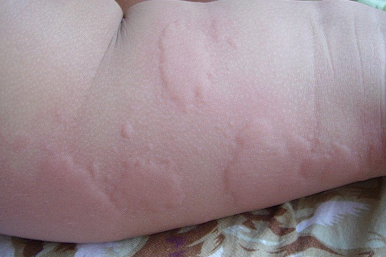 肉松过敏荨麻疹图 肉松过敏荨麻疹图