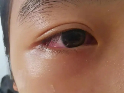 川崎病白眼球红了像出血图.jpg