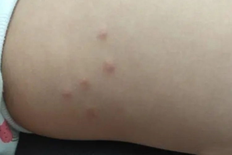 新生儿红斑大腿内侧小疙瘩图
