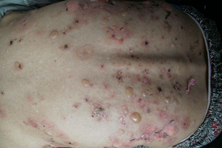 疱疹样天疱疮背部水疱图 疱疹样天疱疮背部水疱图