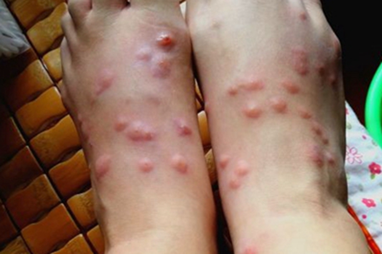 虫咬皮炎大疙瘩图