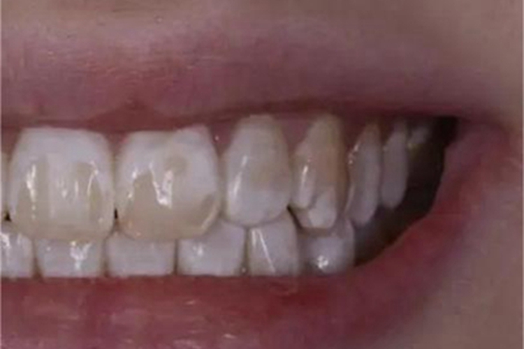 氟牙症牙齿表面不规则斑图 氟牙症牙齿表面不规则斑图