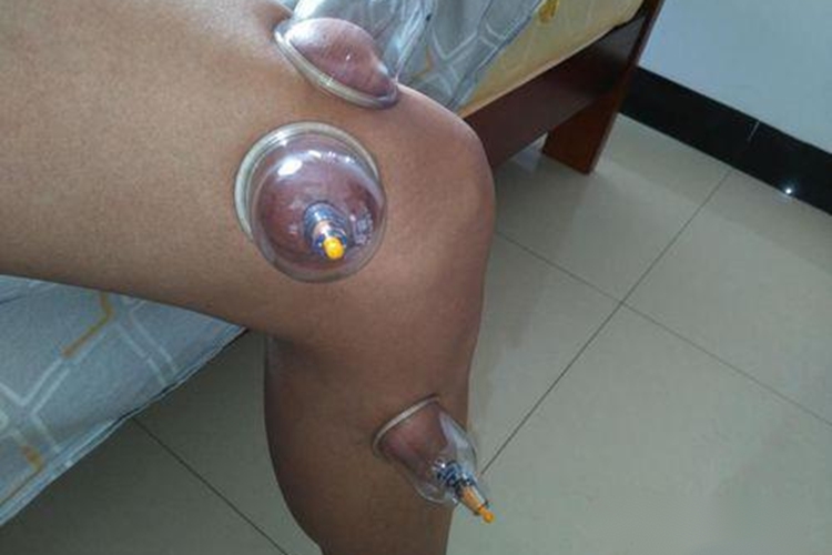 女性腿部留罐图