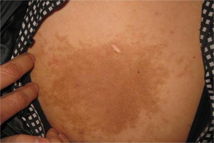泛发型表皮痣胸部症状图