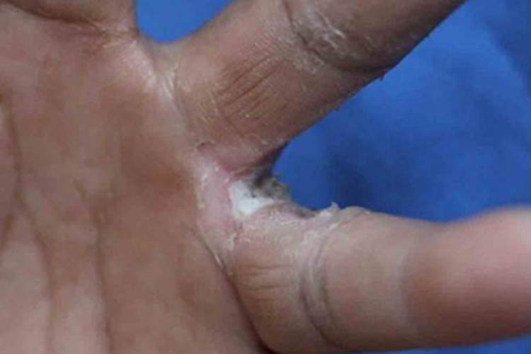 念珠菌性间擦疹手指缝症状图 念珠菌性间擦疹手指缝症状图